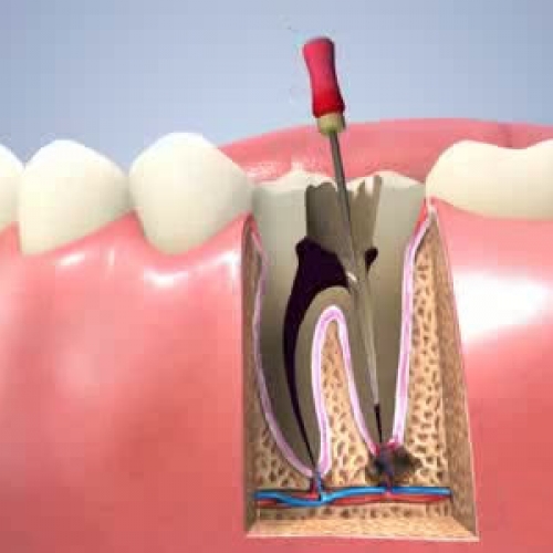 {Endodontics (Root Canal Treatment)}